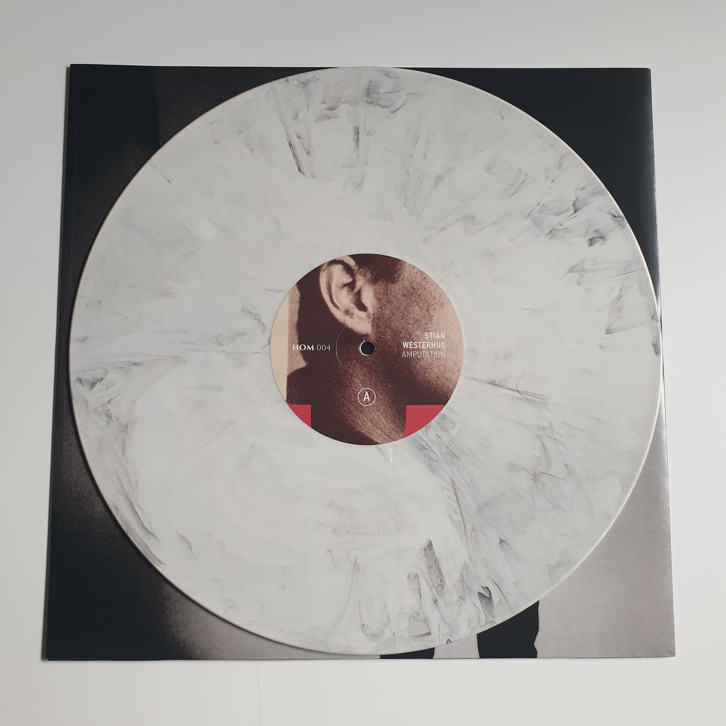STIAN WESTERHUS - Amputation